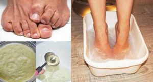 Болки в стъпалата – причини и домашни лекове