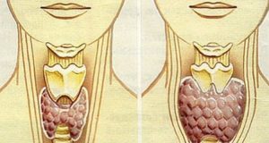 Провериха с ултразвук: Щитовидната ми жлеза е вече нормална