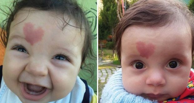 Помните ли бебчето което се роди с белег под формата на сърце? Ето как изглежда 4 години по-късно