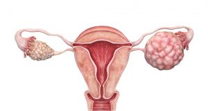 5 тихи симптома за рак на яйчниците при жените които пропускаме! Всяка от нас трябва да ги знае!