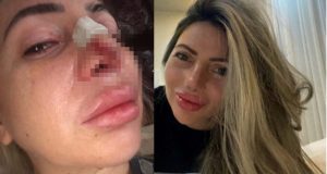 Нечовешко: Млада жена е обезобразена след ринопластика завършила с некроза на носа
